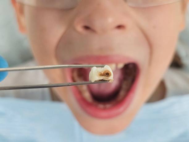 Best Broken or Chipped Tooth Repair in Midfield, AL